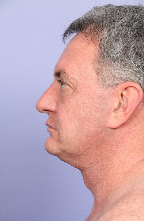 Laser Skin Resurfacing Gallery Before & After Image