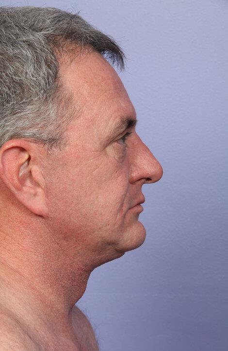 Laser Skin Resurfacing Gallery Before & After Image