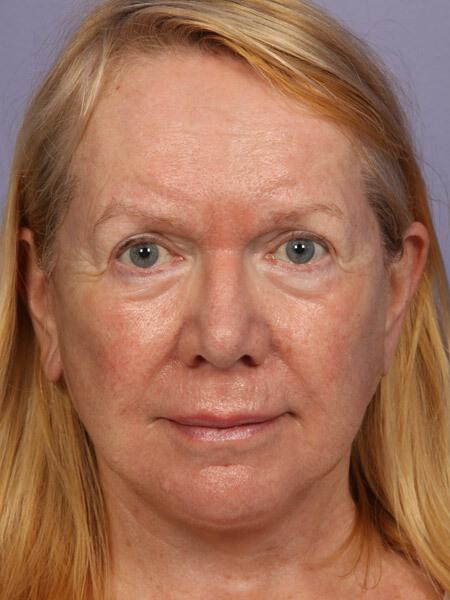 Laser Skin Resurfacing Gallery Before & After Image