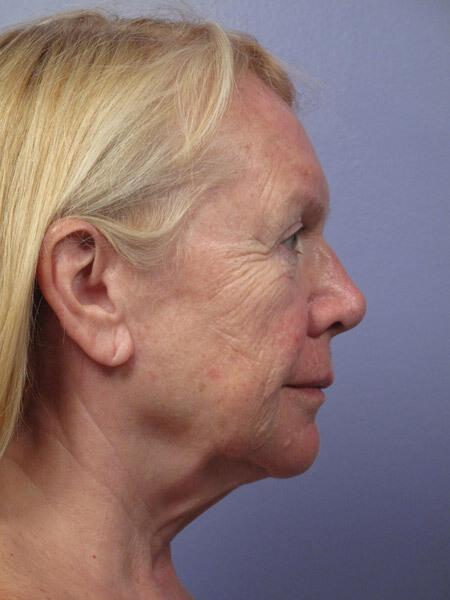 Laser Skin Resurfacing Gallery Before & After Image