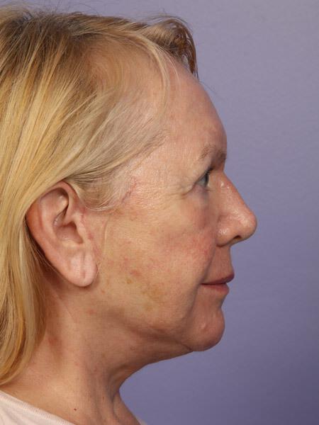 Laser Skin Resurfacing Gallery Before & After Image