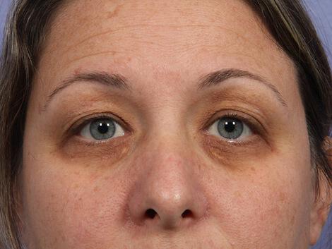 Laser Skin Resurfacing Gallery Before & After Image