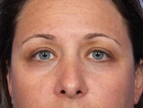 Laser Skin Resurfacing Gallery Before & After Image