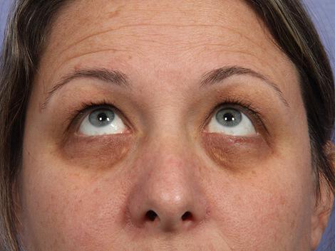 Laser Skin Resurfacing Gallery Before & After Image