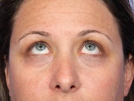 Laser Skin Resurfacing Gallery Before & After Image