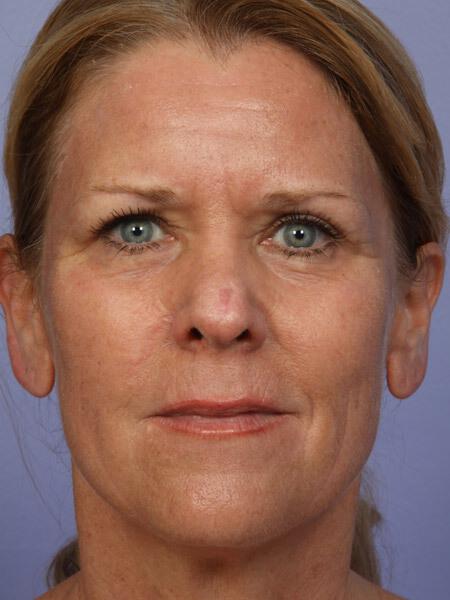 Laser Skin Resurfacing Gallery Before & After Image