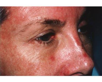 Laser Skin Resurfacing Gallery Before & After Image