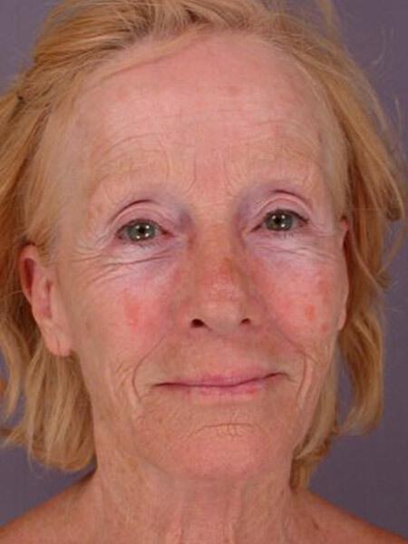 Laser Skin Resurfacing Gallery Before & After Image