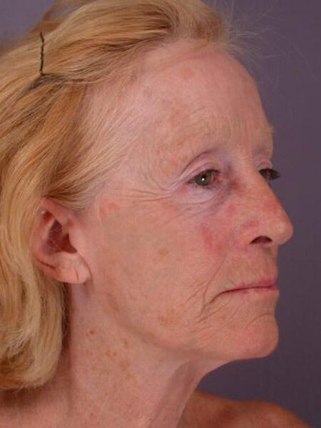 Laser Skin Resurfacing Gallery Before & After Image