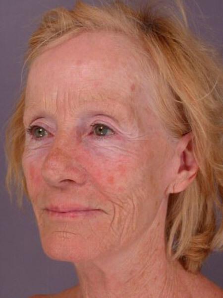 Laser Skin Resurfacing Gallery Before & After Image