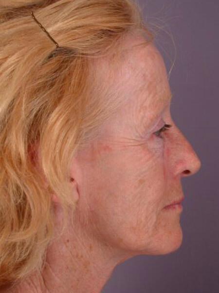 Laser Skin Resurfacing Gallery Before & After Image