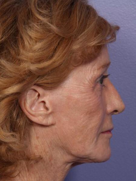 Laser Skin Resurfacing Gallery Before & After Image