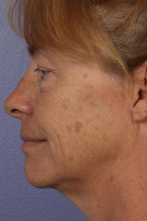 Laser Skin Resurfacing Gallery Before & After Image