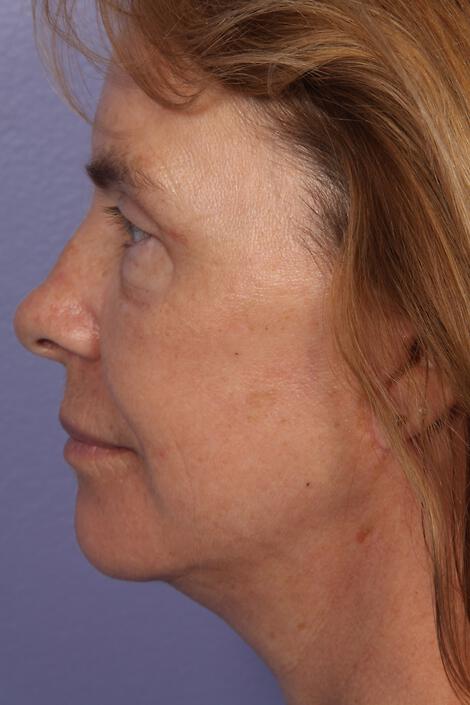 Laser Skin Resurfacing Gallery Before & After Image