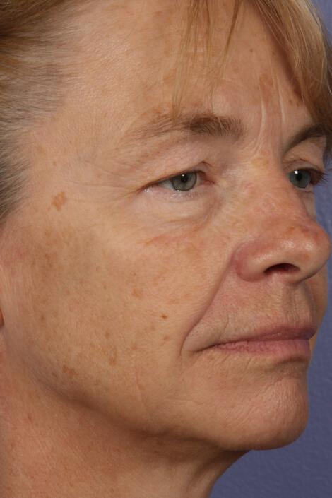 Laser Skin Resurfacing Gallery Before & After Image