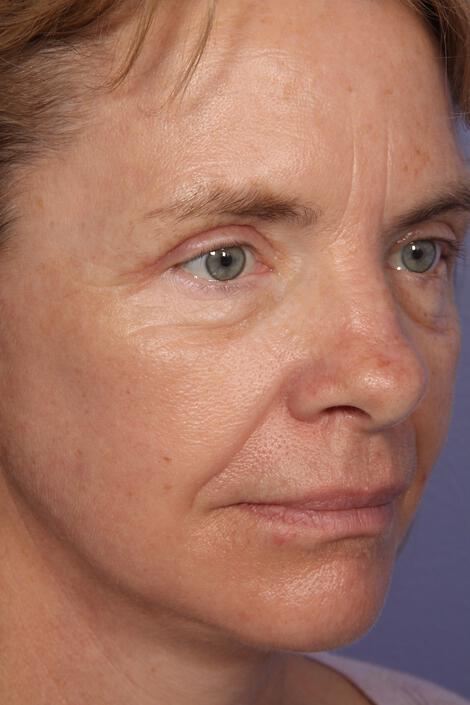 Laser Skin Resurfacing Gallery Before & After Image