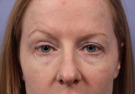 Laser Skin Resurfacing Gallery Before & After Image