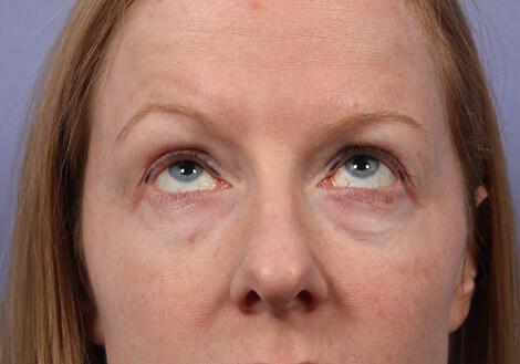 Laser Skin Resurfacing Gallery Before & After Image