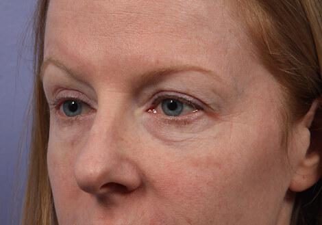 Laser Skin Resurfacing Gallery Before & After Image