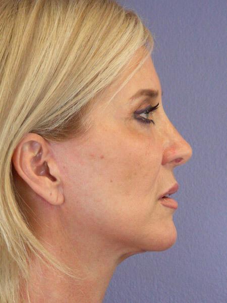 Laser Skin Resurfacing Gallery Before & After Image