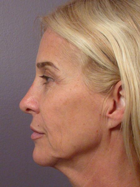 Laser Skin Resurfacing Gallery Before & After Image