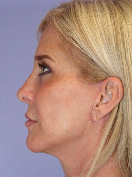 Laser Skin Resurfacing Gallery Before & After Image