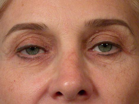 Laser Skin Resurfacing Gallery Before & After Image