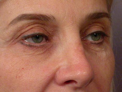 Laser Skin Resurfacing Gallery Before & After Image