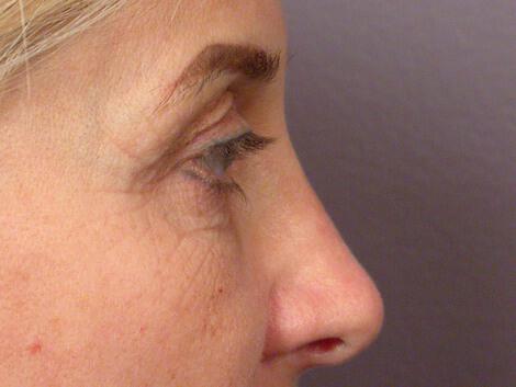 Laser Skin Resurfacing Gallery Before & After Image