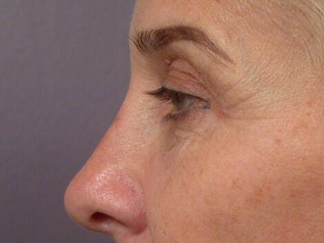 Laser Skin Resurfacing Gallery Before & After Image