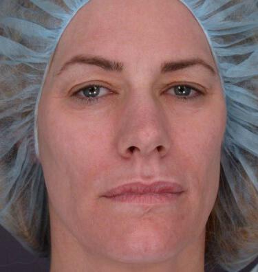 Laser Skin Resurfacing Gallery Before & After Image