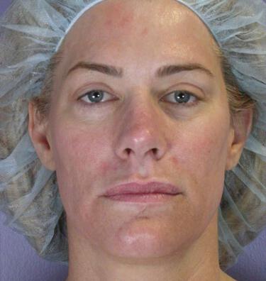 Laser Skin Resurfacing Gallery Before & After Image