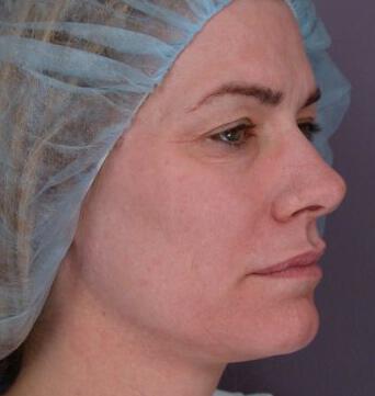 Laser Skin Resurfacing Gallery Before & After Image