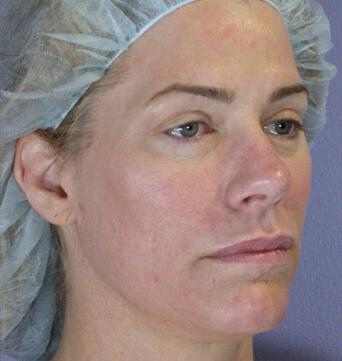 Laser Skin Resurfacing Gallery Before & After Image