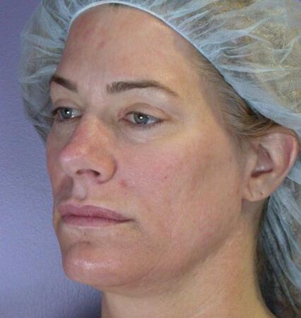 Laser Skin Resurfacing Gallery Before & After Image