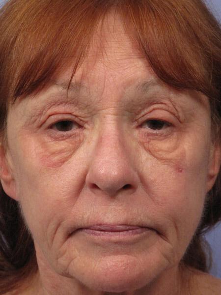 Laser Skin Resurfacing Gallery Before & After Image