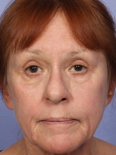 Laser Skin Resurfacing Gallery Before & After Image