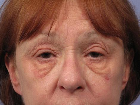 Laser Skin Resurfacing Gallery Before & After Image