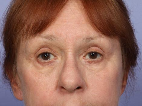 Laser Skin Resurfacing Gallery Before & After Image