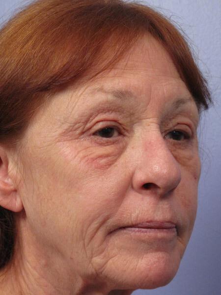 Laser Skin Resurfacing Gallery Before & After Image