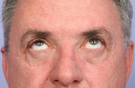 Laser Skin Resurfacing Gallery Before & After Image