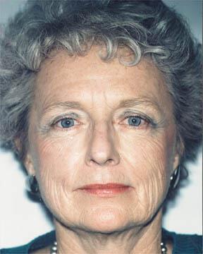 Laser Skin Resurfacing Gallery Before & After Image