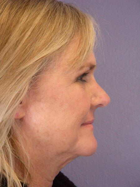 Laser Skin Resurfacing Gallery Before & After Image