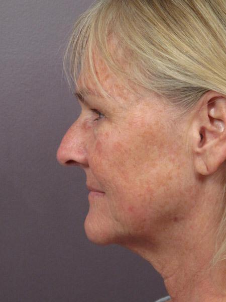 Laser Skin Resurfacing Gallery Before & After Image