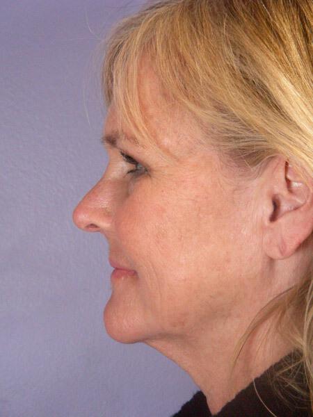 Laser Skin Resurfacing Gallery Before & After Image