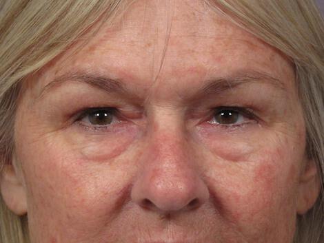 Laser Skin Resurfacing Gallery Before & After Image