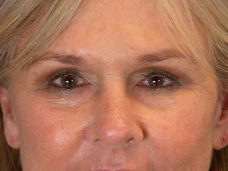 Laser Skin Resurfacing Gallery Before & After Image