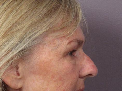 Laser Skin Resurfacing Gallery Before & After Image