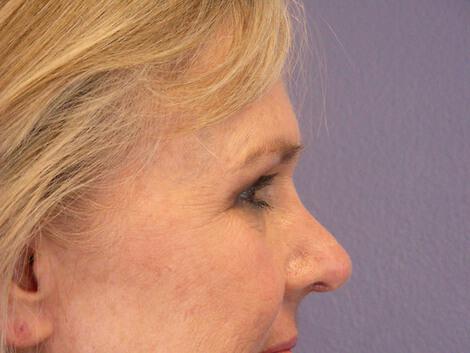 Laser Skin Resurfacing Gallery Before & After Image