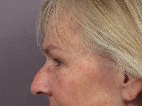 Laser Skin Resurfacing Gallery Before & After Image